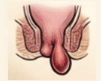 Estrangulamiento hemorroidal: complicación grave