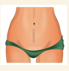 Cirugías abdominales previas como factor de riesgo de hernia abdominal