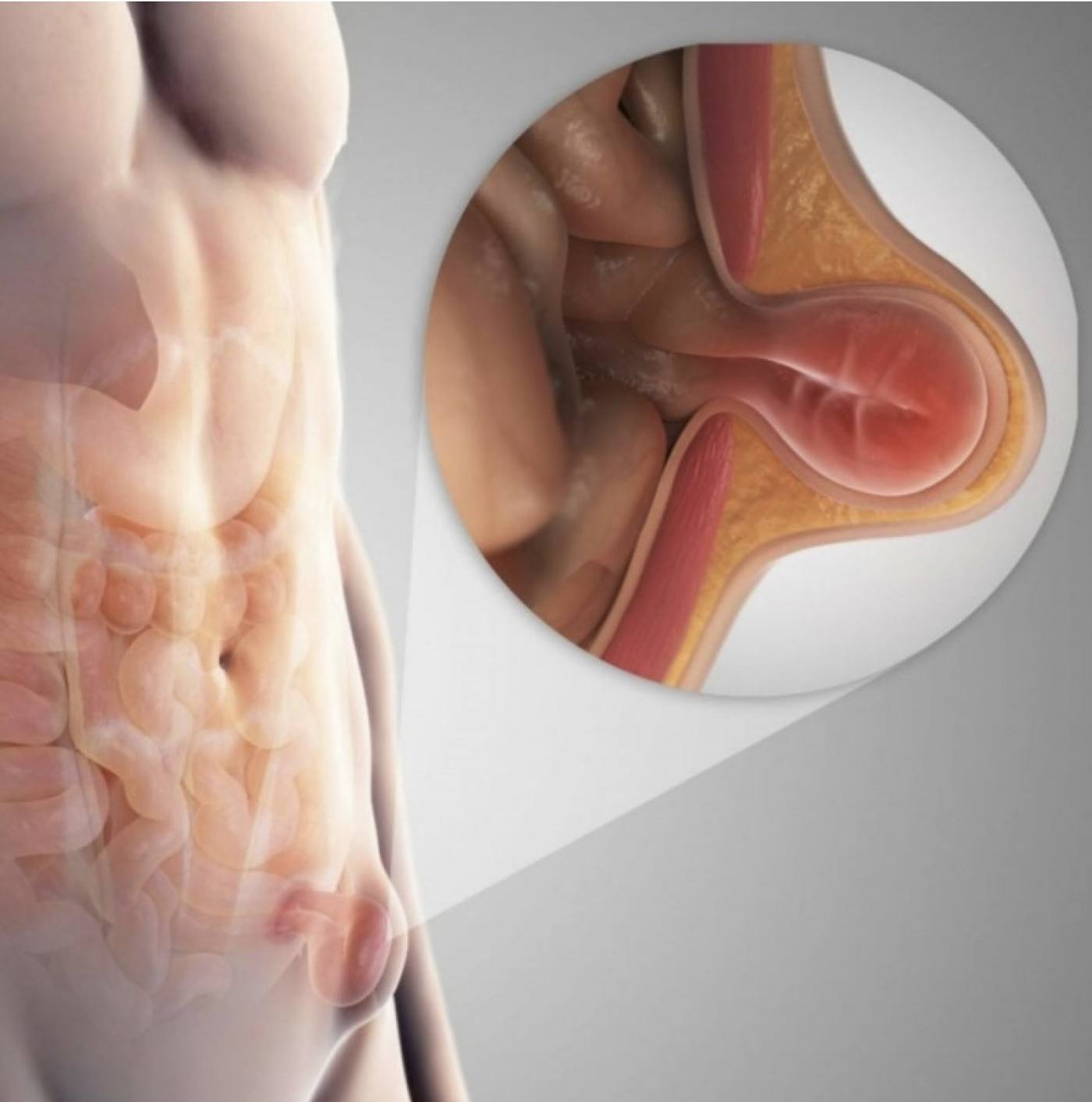 Hernias Abdominales