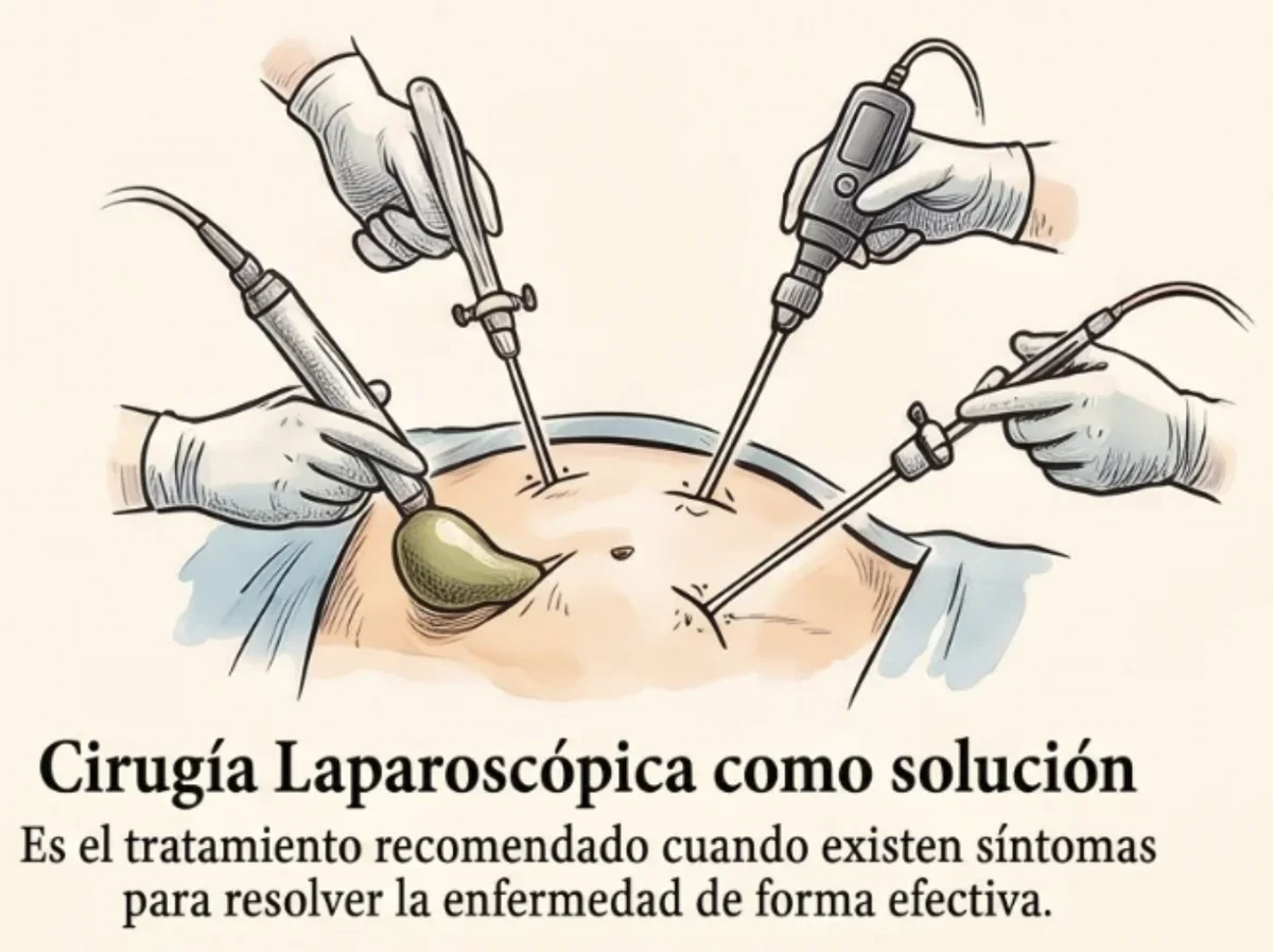 Colecistectomía laparoscópica: cirugía mínimamente invasiva